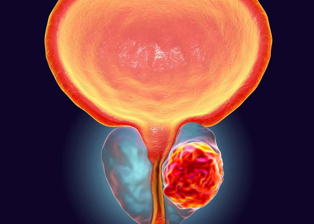 Enlarged Prostate